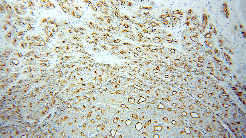 Immunohistochemical of paraffin-embedded human prostate cancer using Catalog No:114371(FOLH1 antibody) at dilution of 1:100 (under 10x lens)