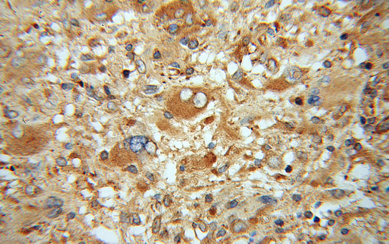 Immunohistochemical of paraffin-embedded human gliomas using Catalog No:110133(dynactin-2 antibody) at dilution of 1:50 (under 40x lens)