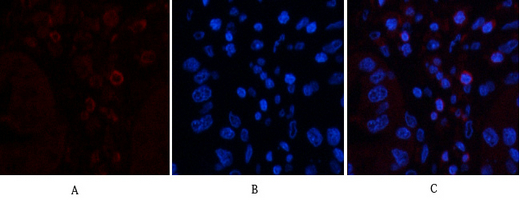Immunofluorescence analysis of human-liver-cancer tissue. 1,CD45 Monoclonal Antibody(12A9)(red) was diluted at 1:200(4°C,overnight). 2, Cy3 labled Secondary antibody was diluted at 1:300(room temperature, 50min).3, Picture B: DAPI(blue) 10min. Picture A:Target. Picture B: DAPI. Picture C: merge of A+B