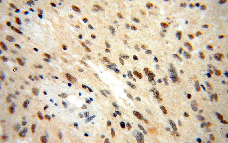 Immunohistochemical of paraffin-embedded human gliomas using Catalog No:113724(PES1 antibody) at dilution of 1:100 (under 40x lens)