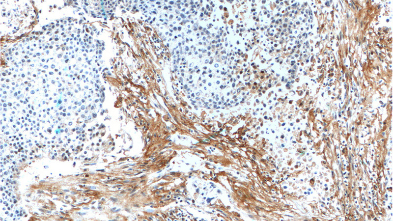 Immunohistochemistry of paraffin-embedded human lung cancer tissue slide using Catalog No:110240(EMILIN2 Antibody) at dilution of 1:200 (under 10x lens).