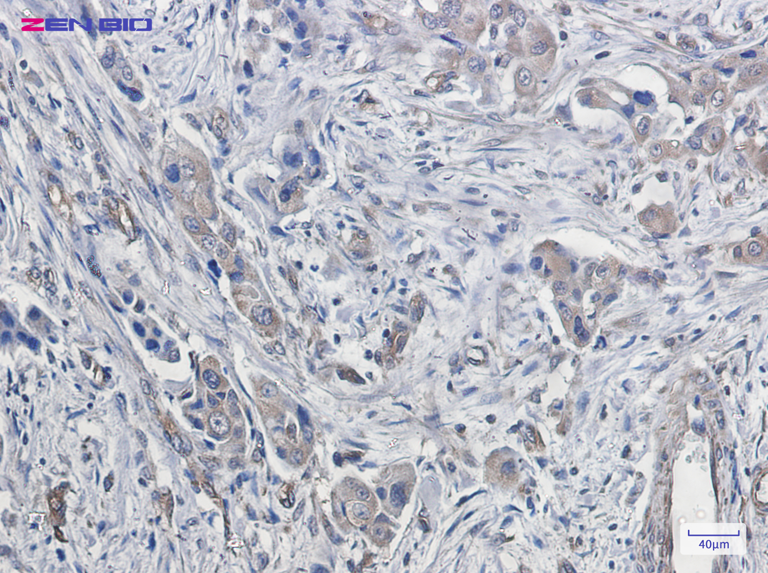 Immunohistochemistry of CDT2 in paraffin-embedded Human lung cancer tissue using CDT2 Rabbit pAb at dilution 1/20