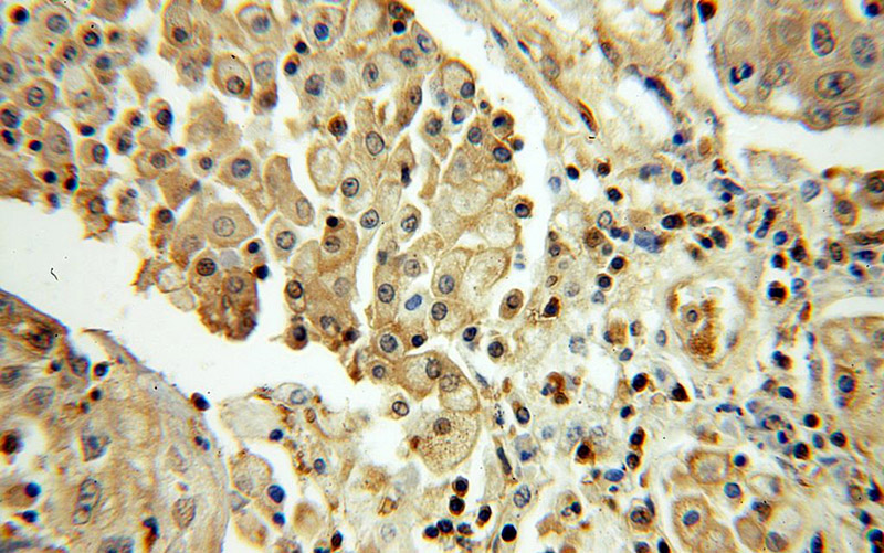 Immunohistochemical of paraffin-embedded human lung cancer using Catalog No:115111(SEPHS1 antibody) at dilution of 1:100 (under 40x lens)