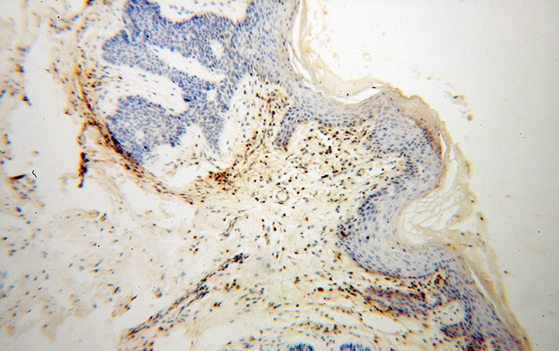 Immunohistochemical of paraffin-embedded human skin cancer using Catalog No:111430(HLA-F antibody) at dilution of 1:100 (under 10x lens)