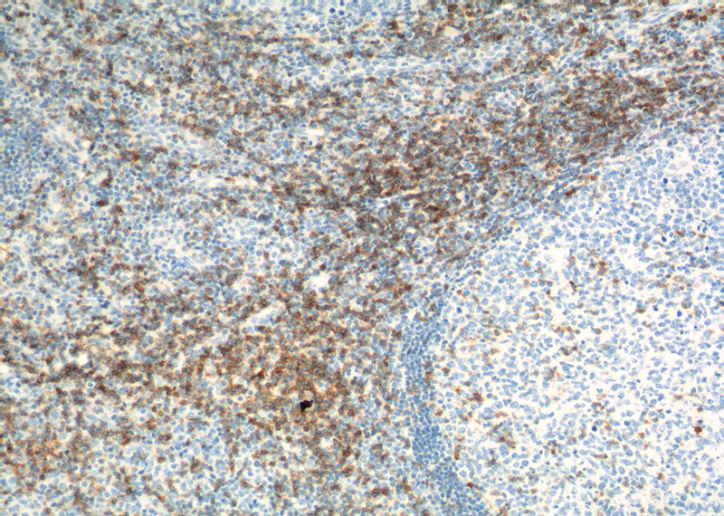 Immunohistochemistry of paraffin-embedded human tonsillitis tissue slide using Catalog No:109132(CD6 Antibody) at dilution of 1:200 (under 10x lens). heat mediated antigen retrieved with Tris-EDTA buffer(pH9).