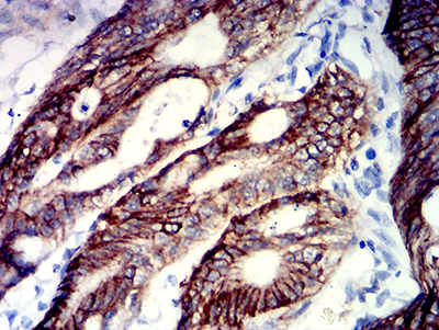 Fig4: Immunohistochemical analysis of paraffin-embedded human colon cancer tissue using anti-TNFRSF18 antibody. The section was pre-treated using heat mediated antigen retrieval with Tris-EDTA buffer (pH 8.0) for 20 minutes. The tissues were blocked in 5% BSA for 30 minutes at room temperature, washed with ddH2O and PBS, and then probed with the primary antibody ( 1/100) for 30 minutes at room temperature. The detection was performed using an HRP conjugated compact polymer system. DAB was used as the chromogen. Tissues were counterstained with hematoxylin and mounted with DPX.