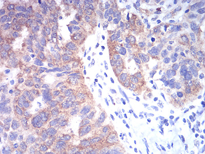 Fig4: Immunohistochemical analysis of paraffin-embedded human ovarian cancer tissue using anti-TBCC antibody. Counter stained with hematoxylin.