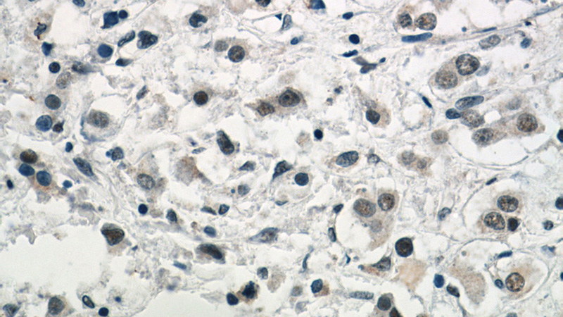 Immunohistochemistry of paraffin-embedded human breast cancer tissue slide using Catalog No:107652(U2AF35 Antibody) at dilution of 1:50 (under 40x lens)
