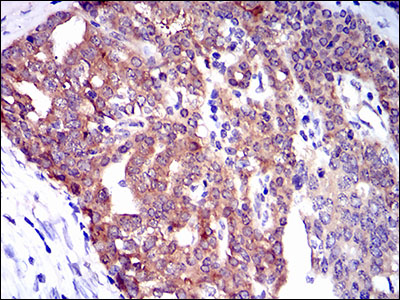 Immunohistochemical analysis of paraffin-embedded ovarian cancer tissues using TWF1 mouse mAb with DAB staining.