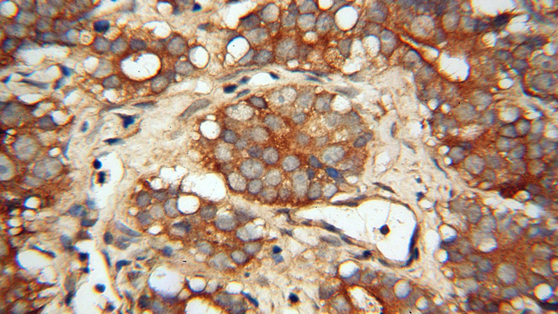 Immunohistochemical of paraffin-embedded human gliomas using Catalog No:110726(FMN2 antibody) at dilution of 1:100 (under 40x lens)