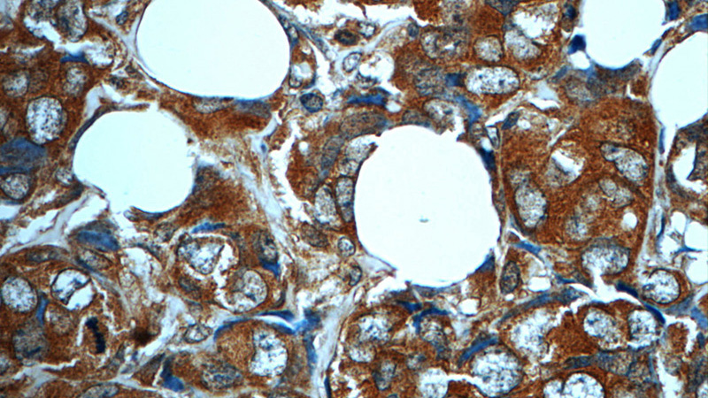 Immunohistochemistry of paraffin-embedded human breast cancer slide using Catalog No:112712(MN1 Antibody) at dilution of 1:50 (under 40x lens)